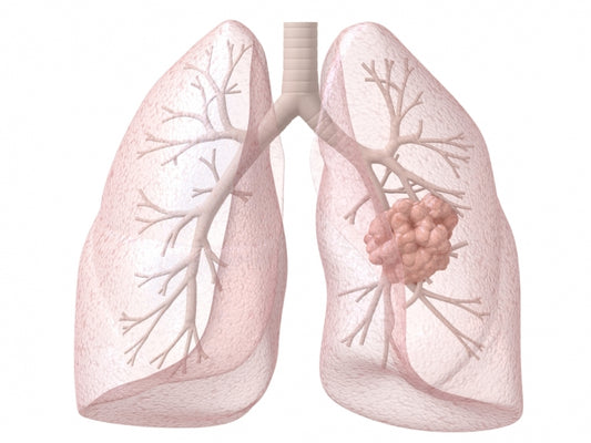 Lung cancer tumours in smokers have 10-times more genetic mutations